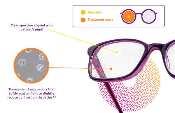 MiSight® Spectacle Lenses